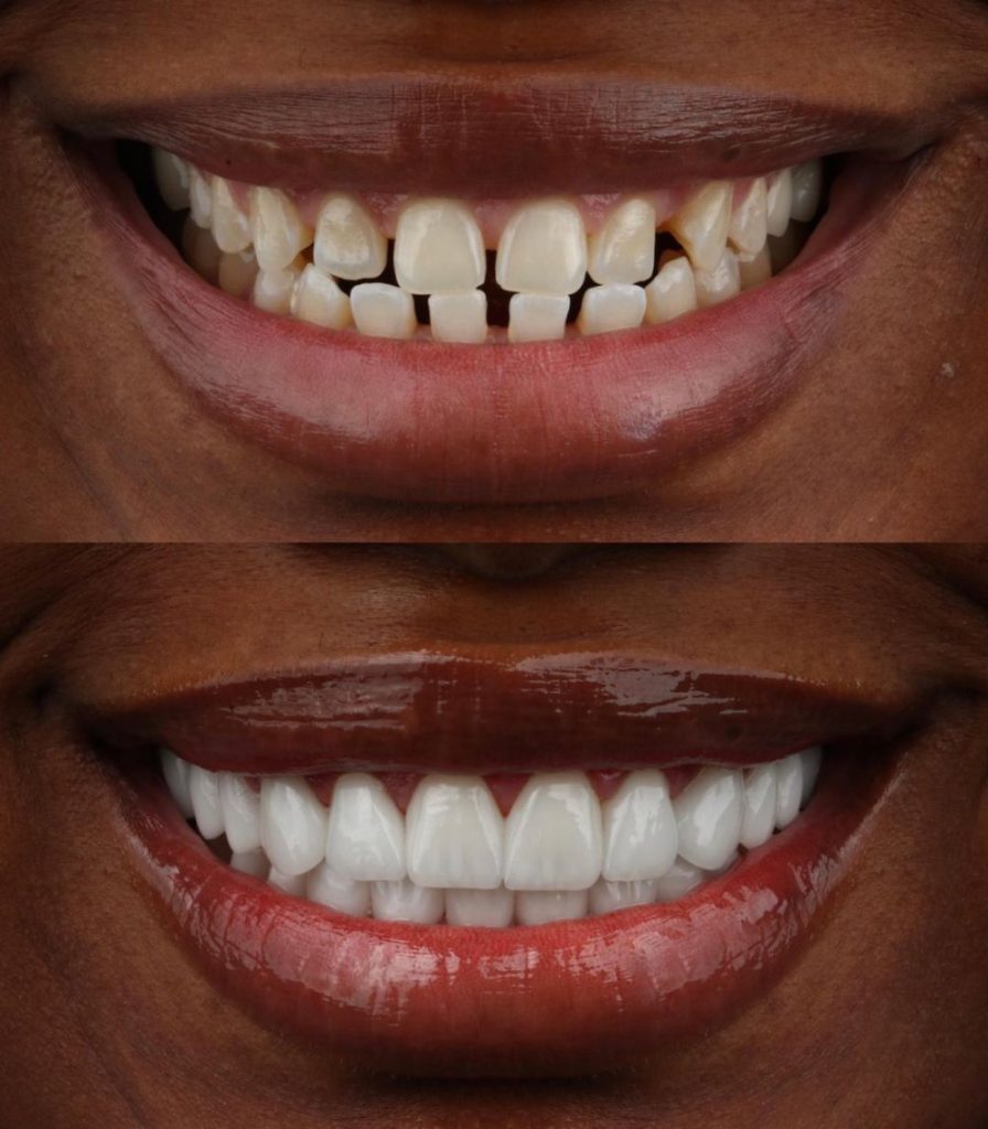 veneers London 