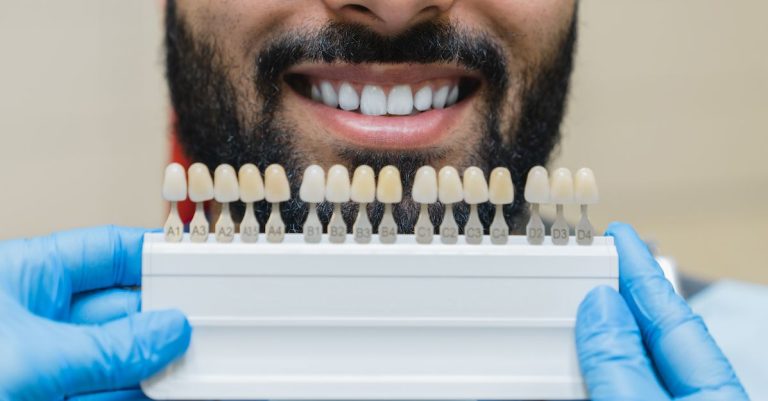 Veneers: London’s Solution for Chipped, Stained, or Misaligned Teeth